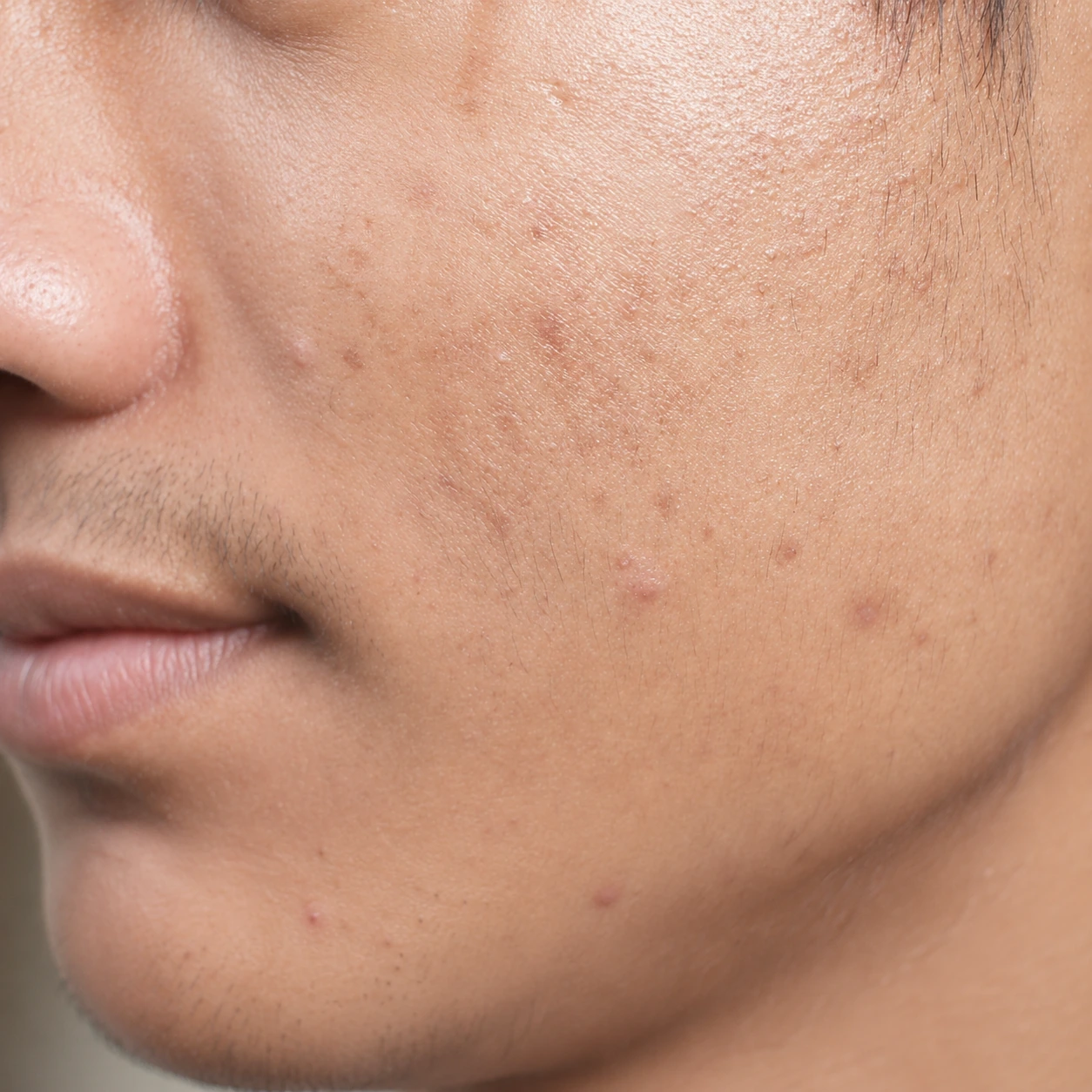 Acne mark scar repair for Korean skin and pigmentation management for men at MeOne Aesthetic Clinic in Dubai